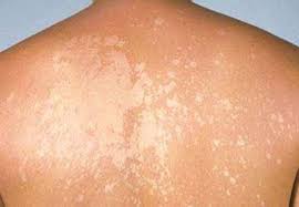 bệnh lang ben gây nhiều phiền toái cho người bệnh