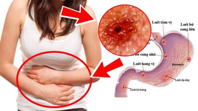 viêm loét dạ dày tá tràng là nỗi ám ảnh của nhiều người