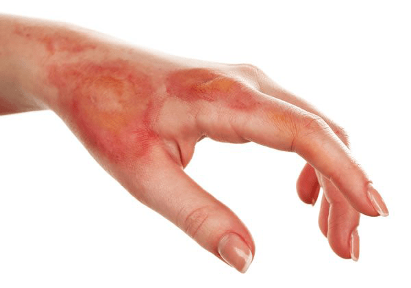 vết bỏng gây đau đớn cho người bệnh