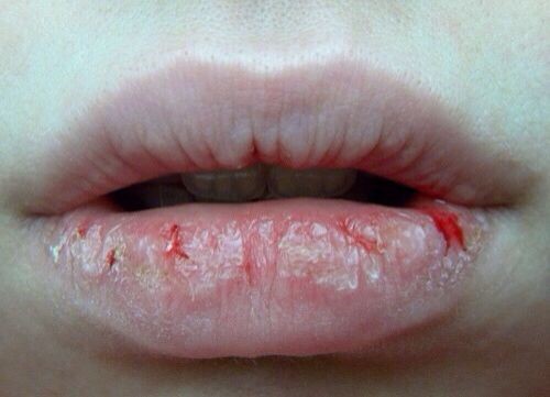 Khô môi gây ra nhiều bất tiện